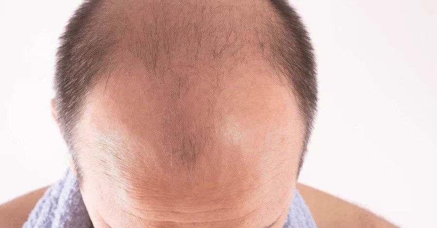 Hair Loss Reasons In Men: does gut health affect hair loss turns into ...