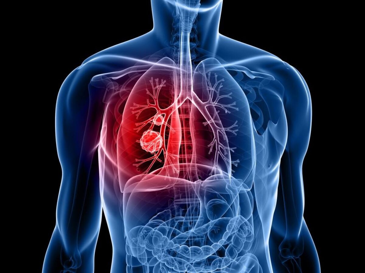 Lung Cancer Reasons: సిగరెట్ స్మోకింగ్, కాలుష్యం మాత్రమే కాదు ఈ 5 కూడా లంగ్ కేన్సర్‌కు కారణాలే