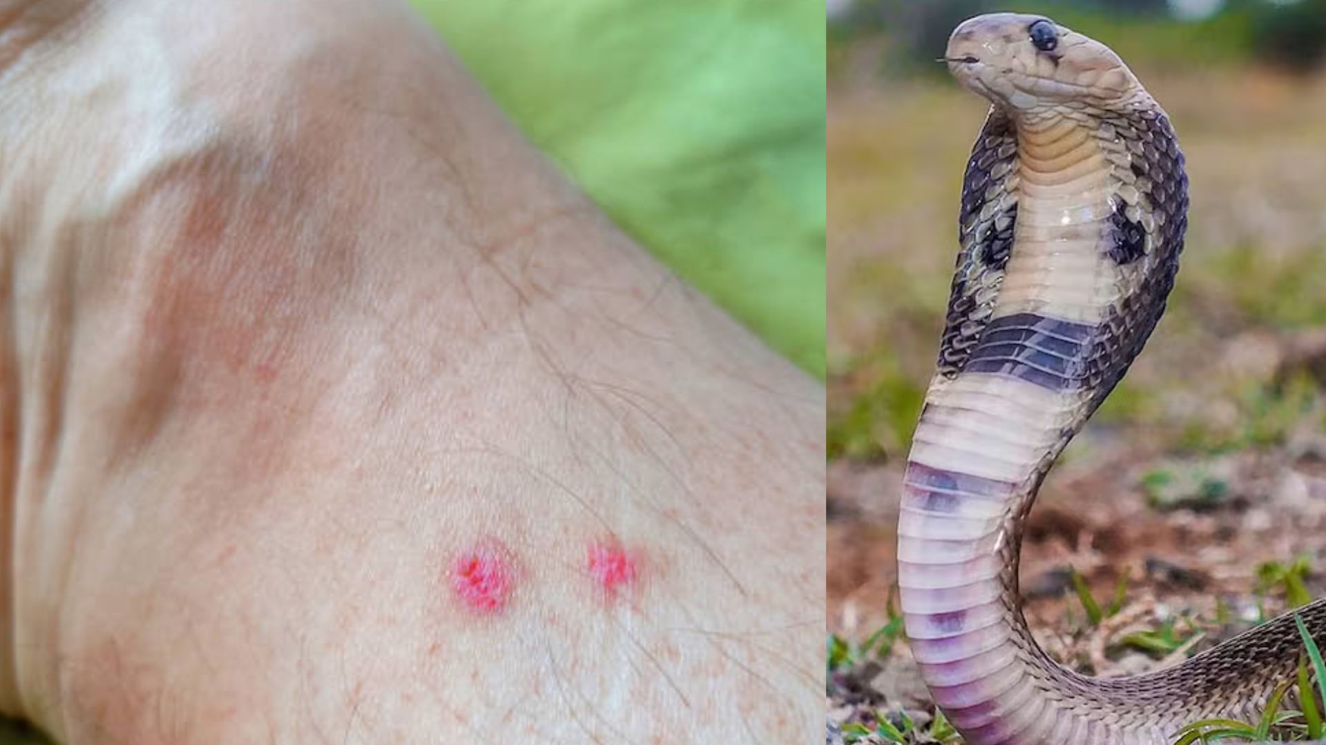 Snake Bite 