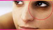 Dark Circles: కళ్ల కింది డార్క్ సర్కిల్స్‌కు వీటితో చెక్! మీరు ట్రై చేయండి..