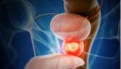 Prostate Cancer Signs: బాడీలోని ఈ 3 భాగాల్లో సమస్య ఉంటే ప్రోస్టేట్ కేన్సర్ కావచ్చు