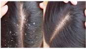 Dandruff: చుండ్రు తగ్గించుకోవడానికి ఇంటి చిట్కాలు.. ఇంతకంటే ఎఫెక్టివ్ రెమిడీనే లేదు..