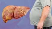 Fatty Liver Treatment: ఫ్యాటీ లివర్తో బాధపడుతున్నారా? సంజీవని లాంటి ఔషధం..కొద్దిరోజుల్లోనే పూర్తి ఆరోగ్యం! Fatty Liver Treatment: ఫ్యాటీ లివర్తో బాధపడుతున్నారా? సంజీవని లాంటి ఔషధం..కొద్దిరోజుల్లోనే పూర్తి ఆరోగ్యం!
