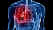 Lung Cancer Reasons: సిగరెట్ స్మోకింగ్, కాలుష్యం మాత్రమే కాదు ఈ 5 కూడా లంగ్ కేన్సర్‌కు కారణాలే