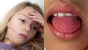 Scarlet Fever: హైదరాబాద్‌లో పెరుగుతున్న స్కార్లెట్‌ ఫీవర్‌.. పిల్లల ఆరోగ్యంపై ఈ జాగ్రత్తలు తప్పనిసరి..