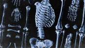 Bone Health: ఎముకలు బలంగా ఉండాలంటే ఇవి తీసుకోవాల్సిందే!!