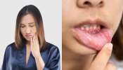 Mouth Ulser Home remedies: మౌత్ అల్సర్ తో బాధపడుతున్నారా..? ఈ సింపుల్ హోమ్ రెమిడీ పాటిస్తే ఇట్టే ఉపశమనం..