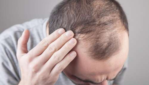 Hair Growth: బట్టతల ఉన్నవారు ఎగిరిగంతేసే వార్త..20 రోజుల్లో జుట్టు మొలిపించే కొత్త సీరమ్..