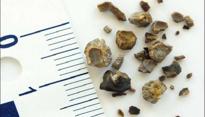 Kidney stones: కిడ్నీలో రాళ్లు తగ్గించుకోడానికి ఇవే సులువైన మార్గాలు