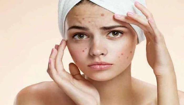 Natural ways to treat Pimples: యవ్వనంలో కలిగే మొటిమలను తగ్గించే సహజ ఔషదాలు & పద్ధతులు 