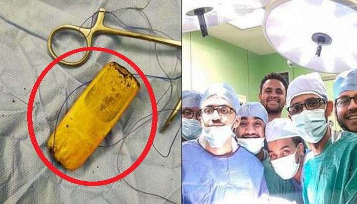 Mobile phone removed from stomach: కడుపులో మొబైల్ ఫోన్.. సెల్ ఫోన్ మింగిన తర్వాత 6 నెలలకు సర్జరీ