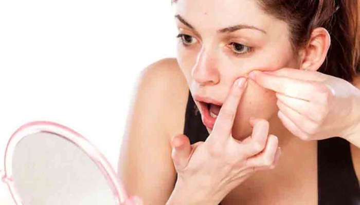 Pimples Cause Foods: మొటిమల సమస్య ఎక్కువగా ఉందా..?? అయితే వీటిని తినకండి 