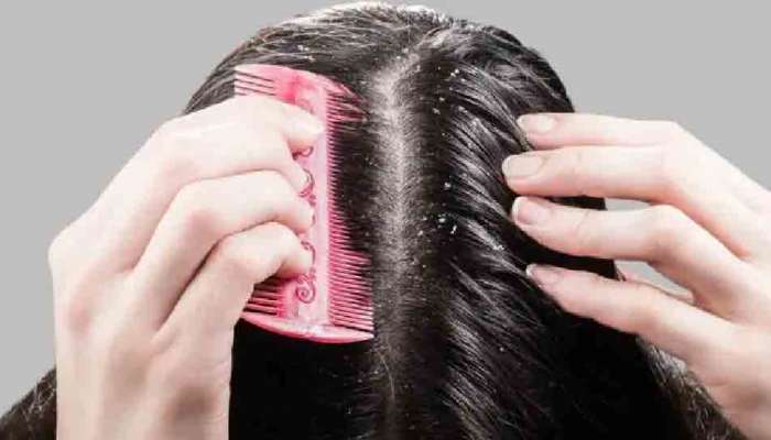 Home Remedies for Dandruff: చలికాలంలో కలిగే డాండ్రఫ్ సమస్యలా..?? ఈ సహజ ఔషధాలను వాడండి