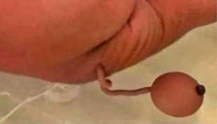 Baby Human Tail: తోకతో పుట్టిన శిశువు...ఆశ్చర్యపోయిన వైద్యులు