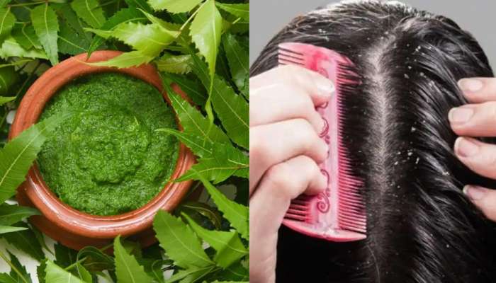 Neem Dandruff: చుండ్రు సమస్యతో బాధపడుతున్నారా? అయితే ఈ చిట్కాలను పాటించండి!