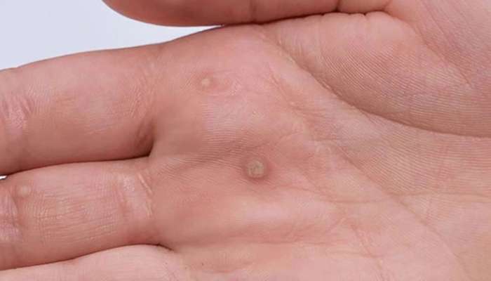 Red Marks on Skin: అరచేతిలో ఎర్రటి మచ్చలు ఉంటే ఆ భయంకరమైన వ్యాధికి సంకేతం!