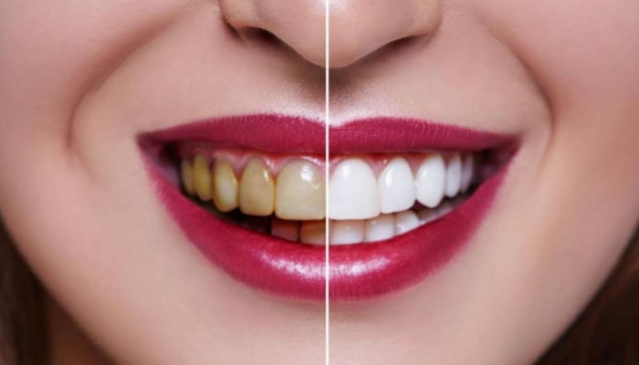 Teeth Cleaning: మీ దంతాలు పసుపు రంగులో ఉన్నాయా? అయితే ఈ టిప్స్ పాటించండి