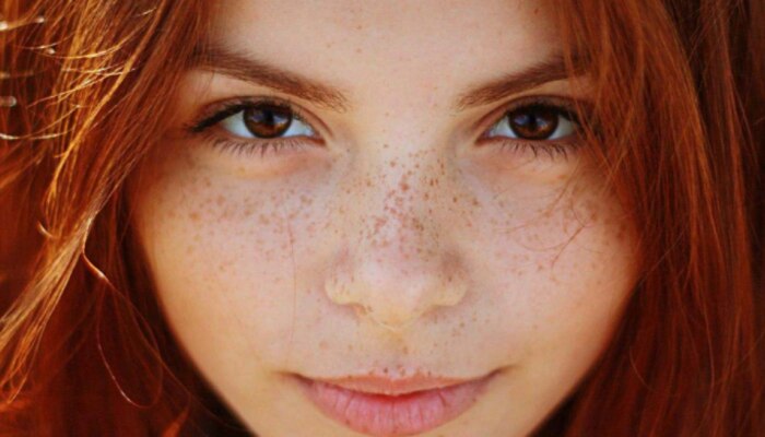Freckle Problems: ముఖంపైన మచ్చలతో ఇబ్బంది పడుతున్నారా? అయితే వాటికి ఇలా చెక్ పెట్టండి