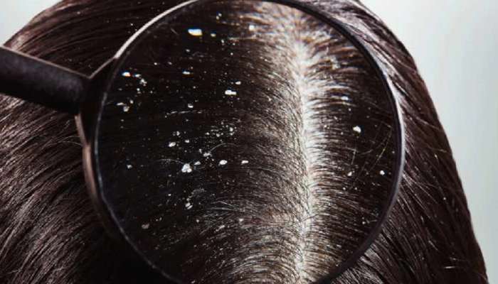 Dandruff Home Remedies: చుండ్రు సమస్యను తగ్గించుకోవడానికి శాశ్వత పరిష్కారం ఇదిగో!