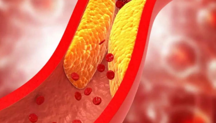 High cholesterol warning Signs: మీ శరీరంలో కొలెస్ట్రాల్ పెరుగుతుందనడానికి సంకేతాలేంటో తెలుసా?