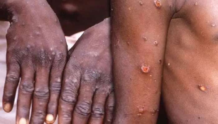  Monkeypox Virus: బ్రిటన్ , అమెరికాలో ఆందోళన కల్గిస్తున్న మంకీపాక్స్ వైరస్ విస్తరణ