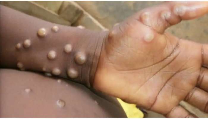 Monkeypox Virus: ప్రపంచ వ్యాప్తంగా మంకీపాక్స్ కలవరం.. 120 కేసులు నమోదు! డబ్ల్యూహెచ్‌వో హెచ్చరిక