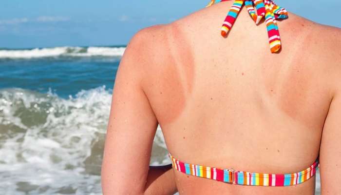Skin Tan Removal: ఈ 5 రకాల నేచురల్ టిప్స్ తో సన్ ట్యానింగ్ ను దూరం చేసుకోవచ్చు!