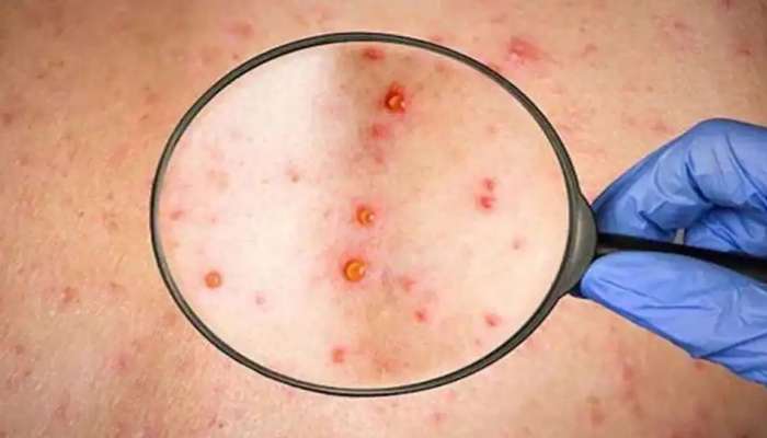 Monkeypox Symptoms: మంకీపాక్స్ ప్రాణాంతకమా? దాని లక్షణాలు ఏంటి? మంకీపాక్స్ కు వ్యాక్సిన్ ఉందా?