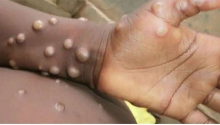 Monkeypox: ప్రపంచవ్యాప్తంగా మంకీపాక్స్‌ వణుకు..తాజాగా ఆయా దేశాల్లో కొత్త కేసులు..!