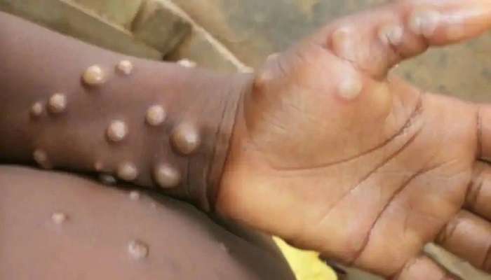 Monkeypox: ప్రపంచవ్యాప్తంగా మంకీ పాక్స్ టెర్రర్..భారత్‌లోనూ తాజాగా కేసు నమోదు..!