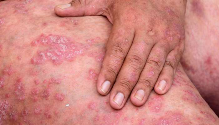 Skin Cancer Symptoms: ప్రమాదకరంగా మారుతున్న చర్మ క్యాన్సర్‌..ఈ లక్షణాలుంటే క్యాన్సరే..!
