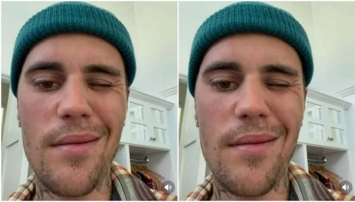 Justin Bieber Facial Paralysis: షాకింగ్... పాప్ స్టార్ జస్టిన్ బీబర్‌కు ముఖ పక్షవాతం... 