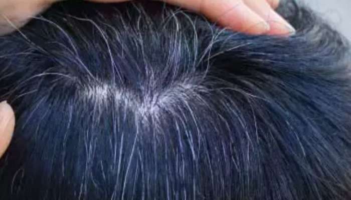 White Hair Solution: చిన్న వయసులోనే తెల్ల జుట్టు వస్తోందా.. ఈ కాయతింటే మీ జుట్టు నల్లగా మారిపోతుంది! 