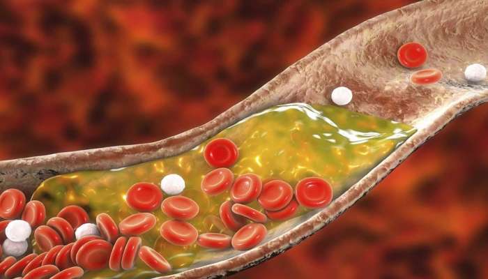 Cholesterol Tips: కొలెస్ట్రాల్‌తో ప్రాణానికే ముప్పు..ఆయుర్వేద చిట్కాలతో అద్భుత వైద్యం
