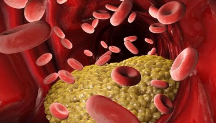 High Cholesterol: శరీరంలో కొలెస్ట్రాల్ ఎక్కువగా ఉంటే ఇవి తినకండి!