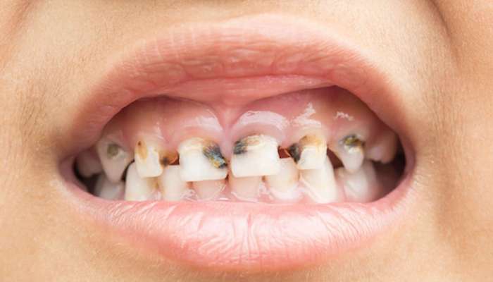 Teeth Cavity: పళ్ల సమస్య, దంతక్షయంతో బాధపడుతున్నారా..ఈ చిట్కా ట్రై చేయండి చాలు