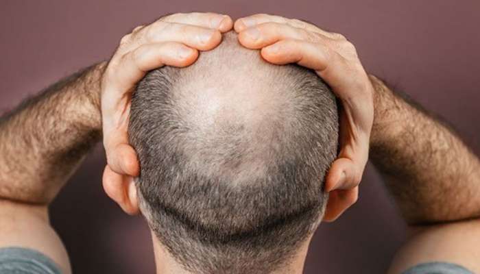 Hair Loss Risk: బట్టతలకు కారణాలు ఇవే.. కావున మీరు బట్టతల రాకుండా ఇవి పాటించండి..!