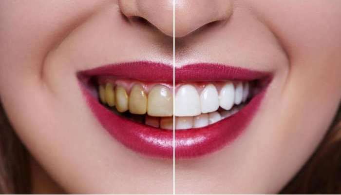Teeth Care Tips: ఆ 4 చెడు అలవాట్లు మానితే..అందమైన, ఆరోగ్యమైన పళ్లు మీ సొంతం
