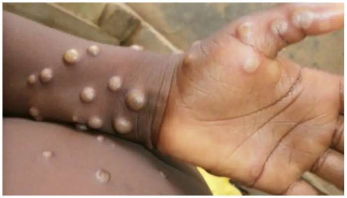 Monkeypox: దేశంలో మంకీపాక్స్ టెర్రర్..తాజాగా వెలుగులోకి కొత్త కేసు..!