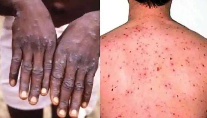 Monkeypox Cases: దేశంలో పెరుగుతున్న మంకీపాక్స్ కేసులు.. కేరళలో మరో కొత్త కేసు నమోదు..