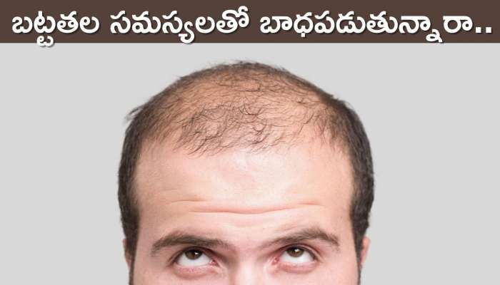 Baldness Prevent In 30 Days: బట్టతల సమస్యలా.. ?? ఇలా చేస్తే 30 రోజుల్లో మంచి ఫలితం!