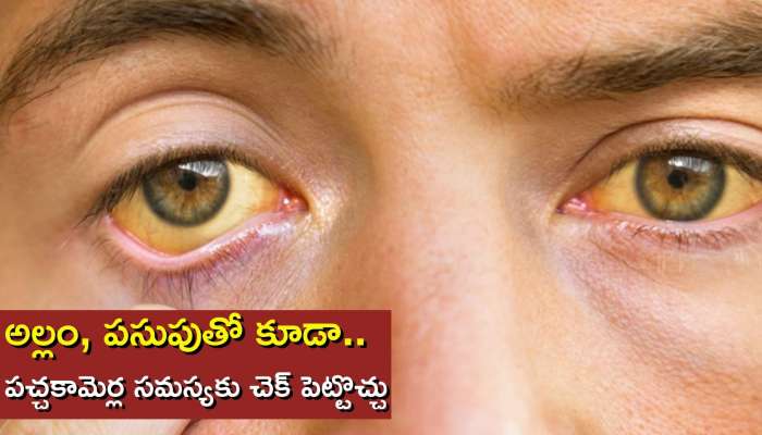 Jaundice Cure in 10 Days: గుడ్‌ న్యూస్‌.. అల్లం, పసుపుతో పచ్చకామెర్లకు 10 రోజుల్లో చెక్‌..!