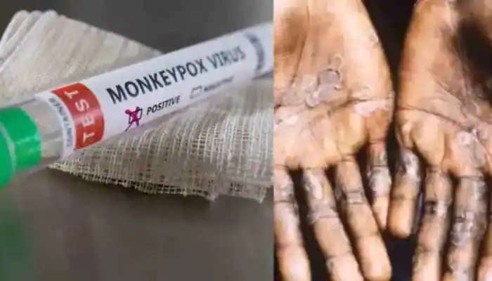 Monekypox Cases Updates: ఢిల్లీలో ఐదో మంకీపాక్స్ కేసు... ఆసుపత్రిలో చేరిన 22 ఏళ్ల యువతి..