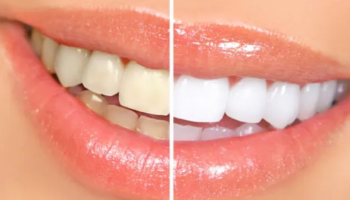 Shining Teeth Tips: మెరిసే దంతాల కోసం వంటింటి చిట్కాలు..