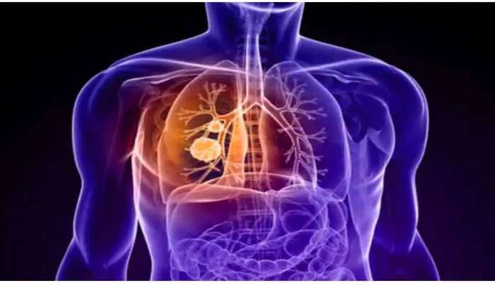 World Lungs Day: మీ ఊపిరితిత్తులు ఆరోగ్యంగా ఉన్నాయా లేవా..ఇలా తెలుసుకోండి