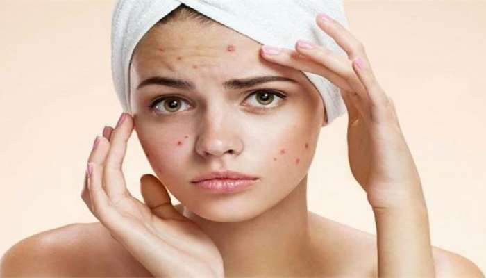 Pimple Care Tips: ముఖంపై మొటిమల సమస్య బాధిస్తోందా..ఇలా చేస్తే 10 రోజుల్లో మాయం