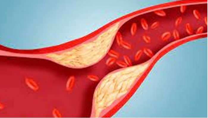 Cholesterol Tips: ఈ ఆహార పదార్ధాలు తీసుకుంటే కేవలం 21 రోజుల్లో కొలెస్ట్రాల్‌కు చెక్