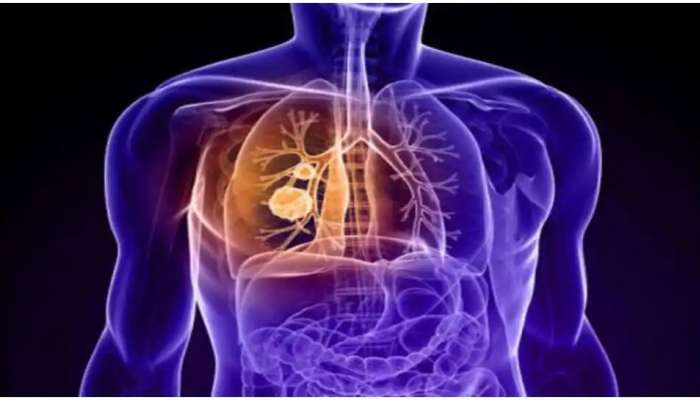 Lungs Cancer Symptoms: లంగ్ కేన్సర్ లక్షణాలేంటి, ఎలా గుర్తించవచ్చు