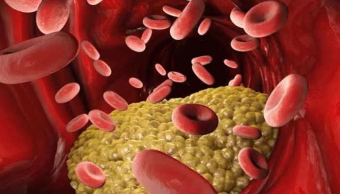 Cholesterol Precautions: కొలెస్ట్రాల్ సమస్యను కేవలం నెలరోజుల్లో మాయం చేసే 4 ఆయుర్వేద చిట్కాలు