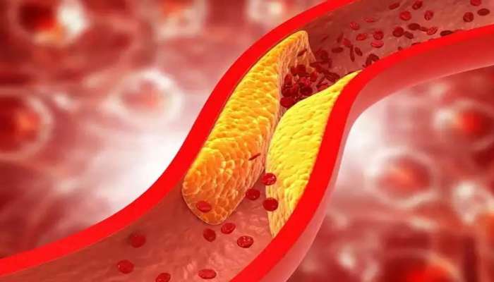 Cholesterol Symptoms: శరీరంలో కొలెస్ట్రాల్ ఎక్కువైందా..ఈ లక్షణాలతో తెలుసుకోవచ్చు